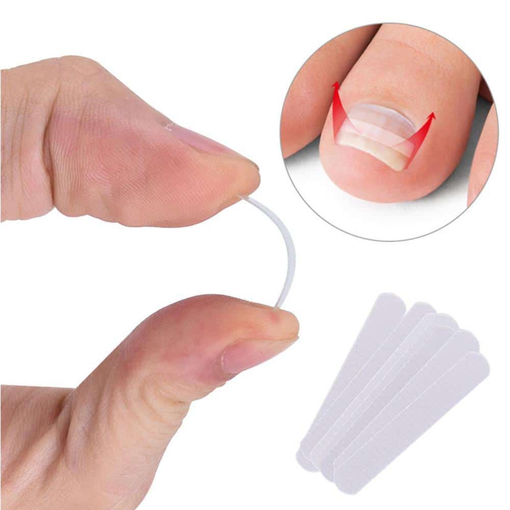Ingrown Toe Nail Correction Sticker