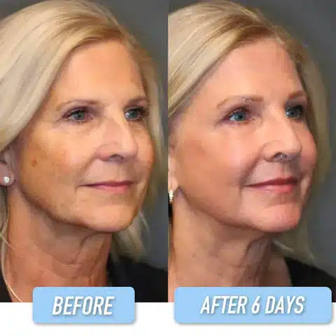 LORX Bôtôx face serum