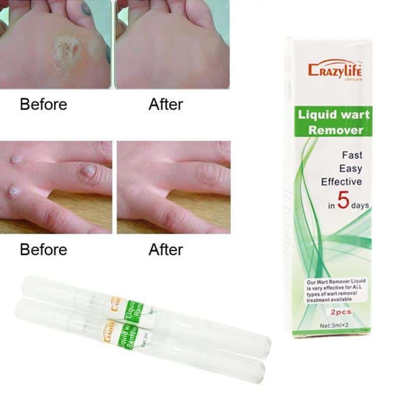 WipeOff Tags & Moles Remover