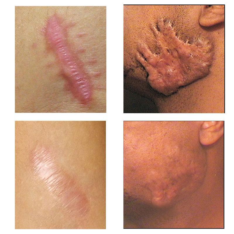 Youthful Scar Remover Cream