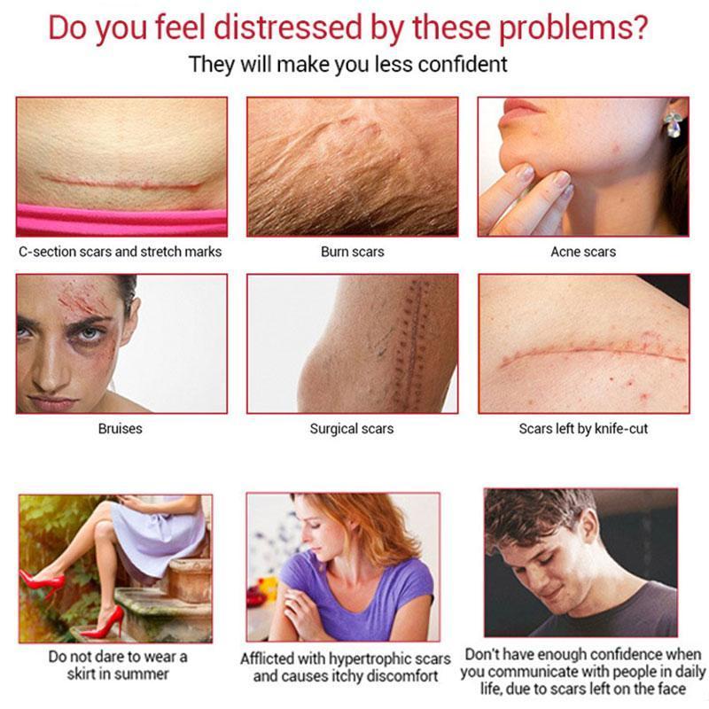 Youthful Scar Remover Cream