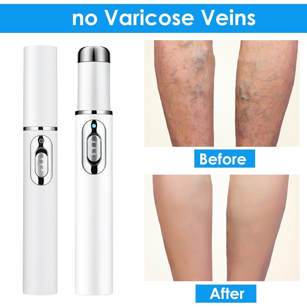 BlueLight™ Therapy Pen for Varicose Veins