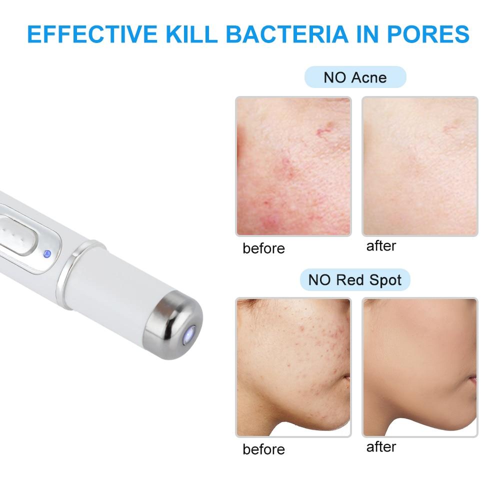 BlueLight™ Therapy Pen for Varicose Veins