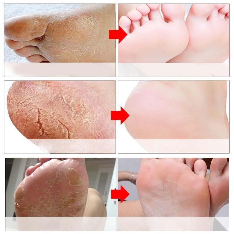 BabySkin Ultimate Foot Peeling Mask