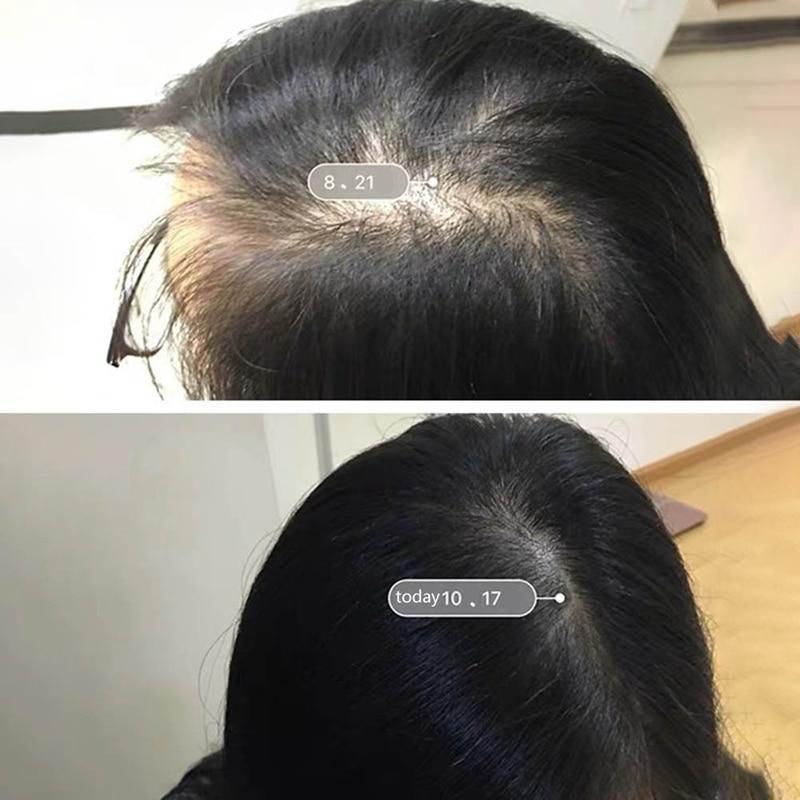 Scalp Intense Roll-on Hair Growth Serum