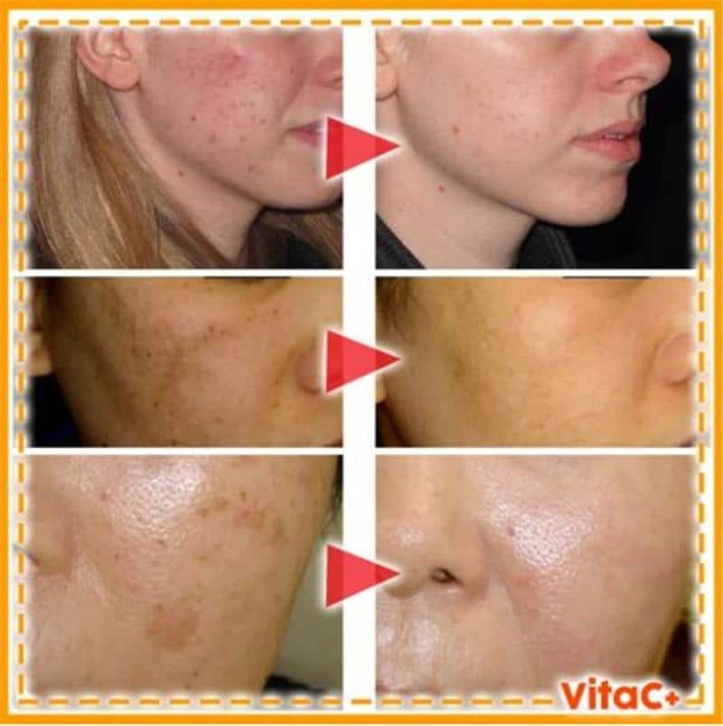 Instant Blemish Removal Gel