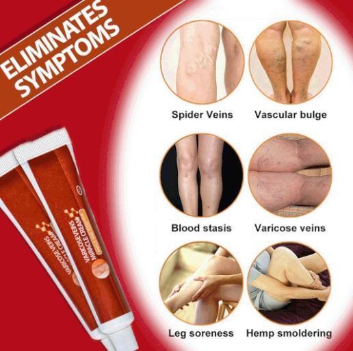 Varicose Veins Miracle Cream