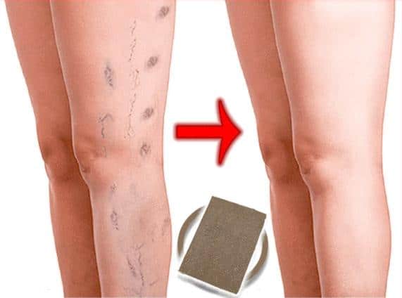 Varicose Veins Herbal Healing Patch