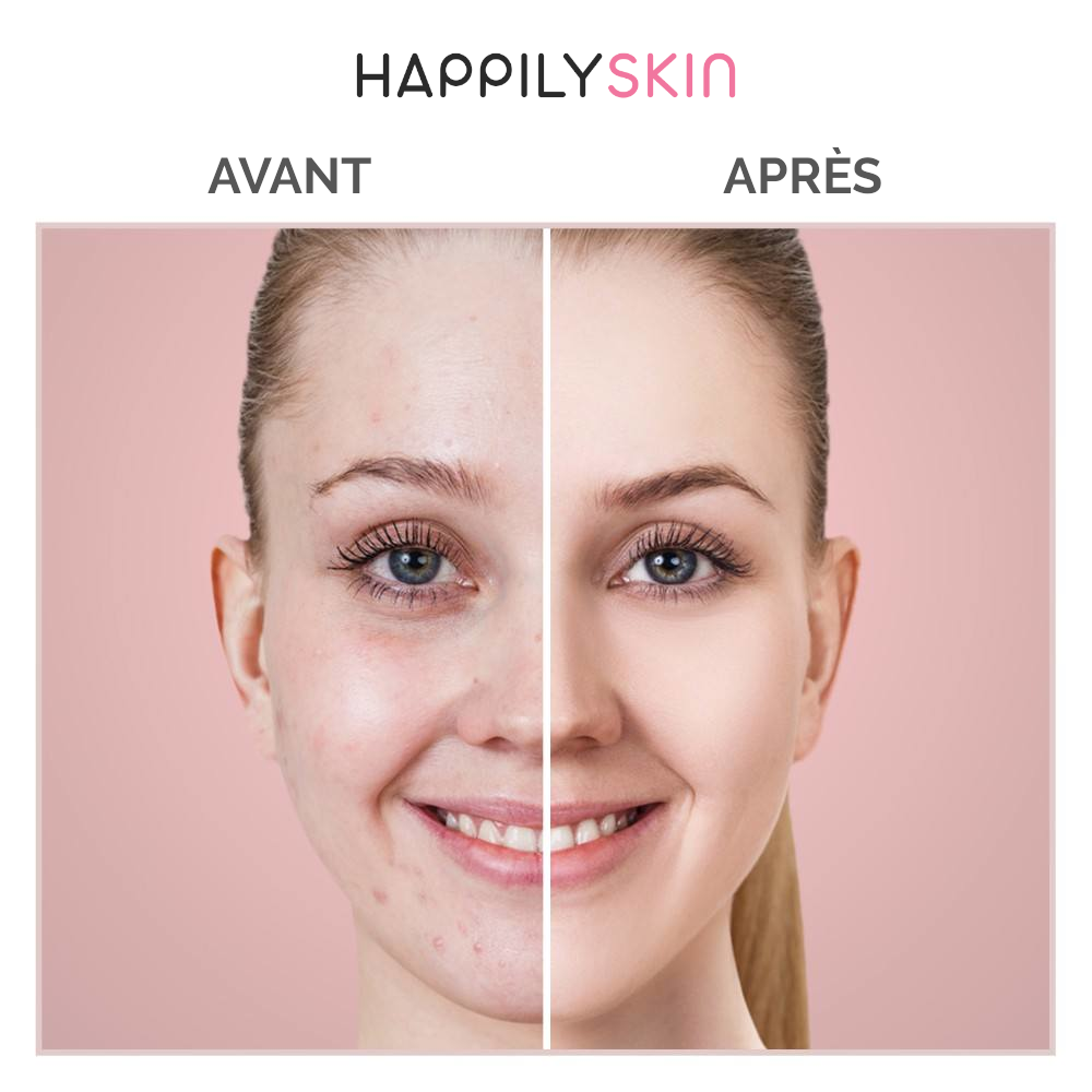happilyskin blackhead vacuum cleaner