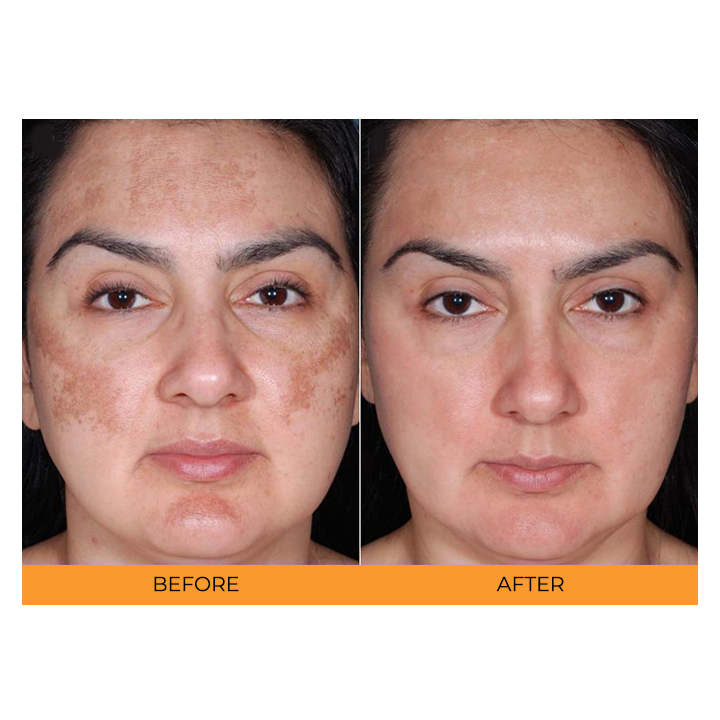 Sauvasine™ Turmeric Dark Spot Serum