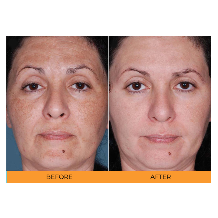 Sauvasine™ Turmeric Dark Spot Serum