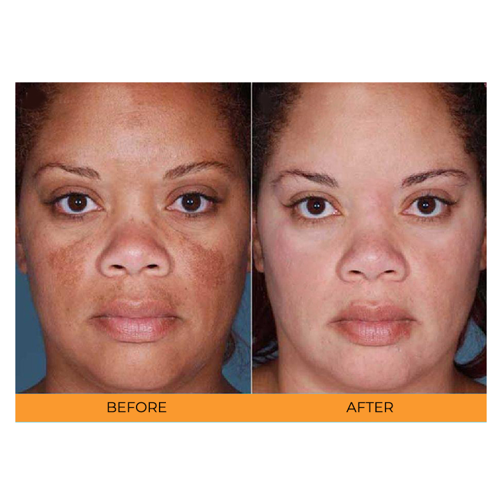 Sauvasine™ Turmeric Dark Spot Serum